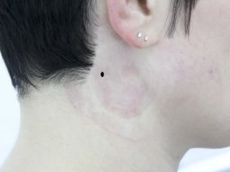 dermal anchor - markierung der stelle